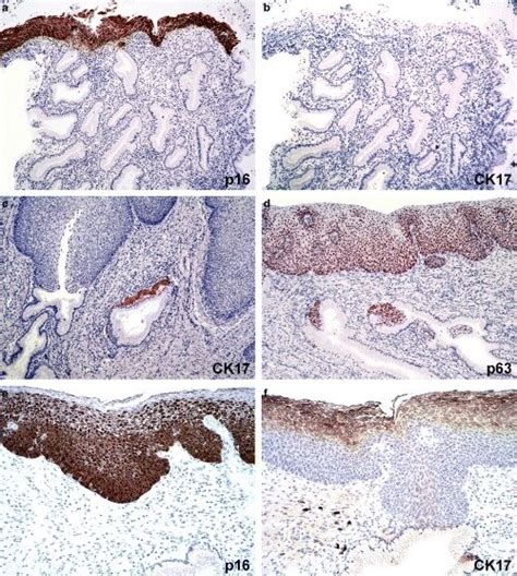 Cervical Intraepithelial Neoplasia CIN III With P16 A And