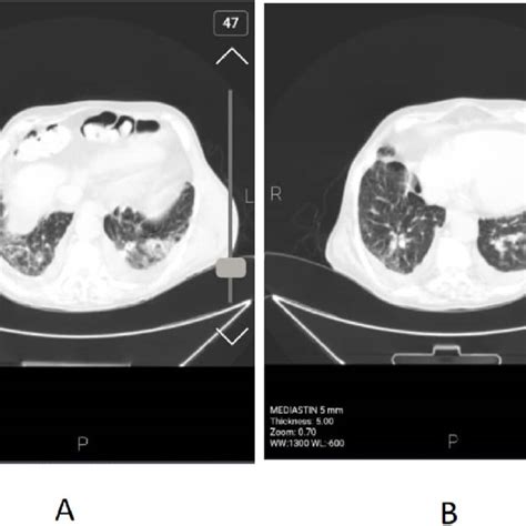 Chest Ct Imaging Shows Ground Glass Opacities Ggo Pattern With Mild Download Scientific