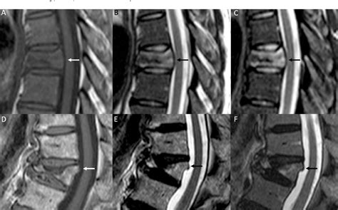 Figure 5 From Differential Diagnosis Of Benign And Malignant Vertebral Compression Fractures