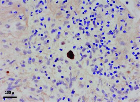 Epstein Barr Virus In Situ Hybridization Demonstrating Strong Nuclear Download Scientific