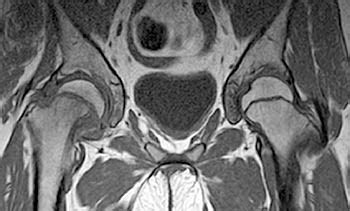 Slipped Capital Femoral Epiphysis - Radsource