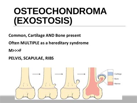 Bone tumours