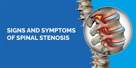 Signs And Symptoms Of Spinal Stenosis