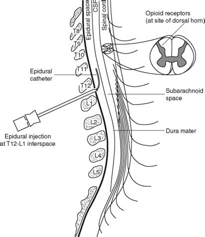 Intrathecal Vs Epidural Space