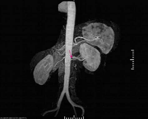 Image Renovascular Hypertension Magnetic Resonance Angiography Msd Manual Professional Edition