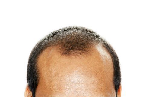 Hair Thinning at Crown - Male & Female Baldness Treatment