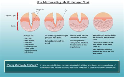 Microneedling Radiance Weston Medspa