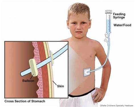 Managing And Caring For Enteral Feeding Tubes Actionable Intelligence