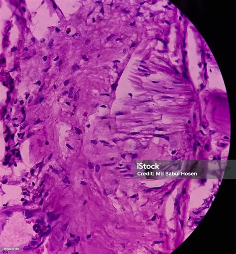 Dermoid Cyst Mature Cystic Teratoma Show Skin Adnexal Structure Fatty