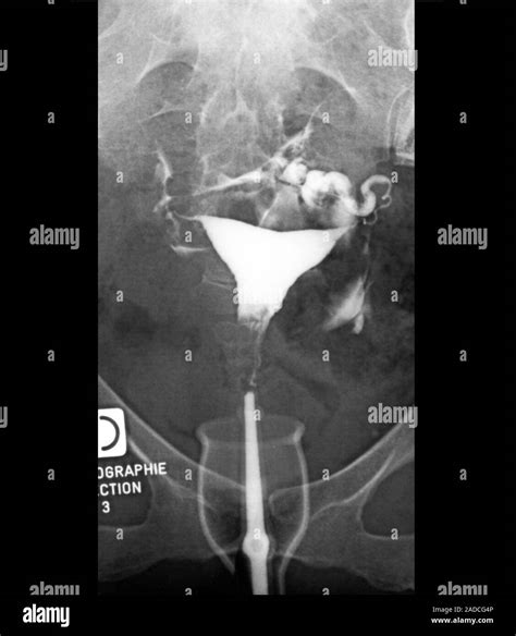 Retroverted Uterus Hystero Salpingogram Contrast Medium X Ray Of The