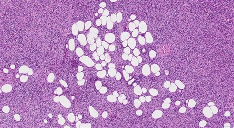 Dermatofibrosarcoma protuberans | Ottawa Atlas of Pathology