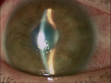 Figure 2 From Argon Laser Iridoplasty In The Management Of Uveitis