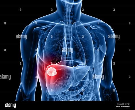 Liver Cancer Hi Res Stock Photography And Images Alamy