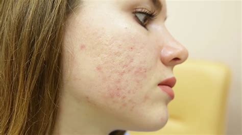 Qual Il Migliore Trattamento Delle Cicatrici Da Acne