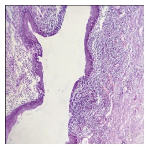 Histopathological Examination Of Resected Specimen A Low Power View