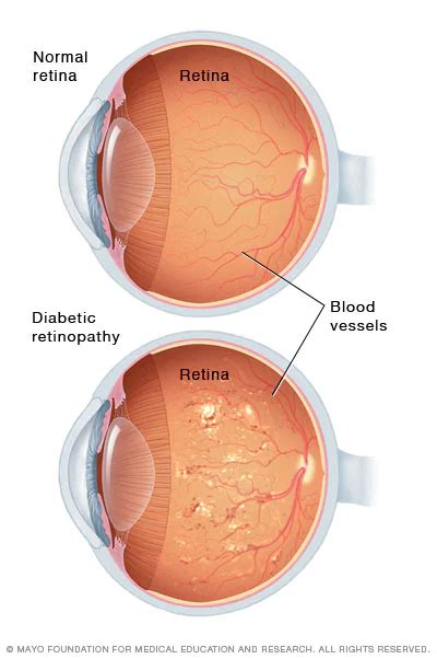 Diabetic Retinopathy Treatment Best Therapies Advances Norlase