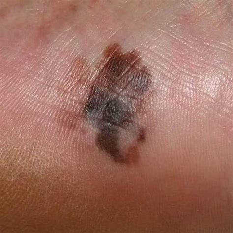 Superficial Spreading Melanoma Foot