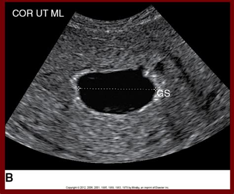 Early Pregnancy Bleeding Flashcards Quizlet