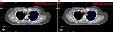 Mono Versus Dual Isocentric Technique For Breast Cancer Radiotherapy