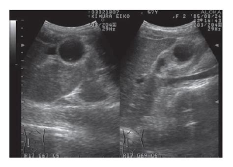 Volvulus Of The Gall Bladder Diagnosed By Ultrasonography Computed