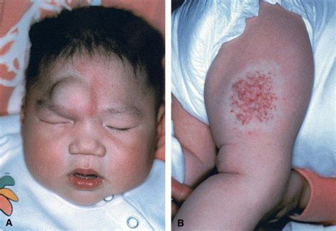 Congenital Hemangiomas And Infantile Hemangioma Missing Links Journal Of The American Academy