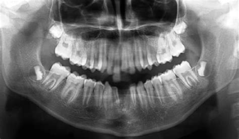 Periapical Radiograph Of The Upper Central Incisors Before Treatment