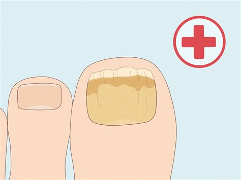 How to Cure Nail Fungus: Home Remedies & Medical Treatments