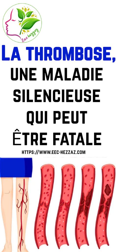 La thrombose une maladie silencieuse qui peut être fatale