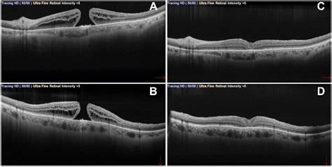 Full Thickness Macular Hole FTMH In Pre Operative A And B