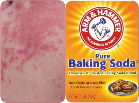 Baking Soda Bath for Hives [Benefits & Preparation]