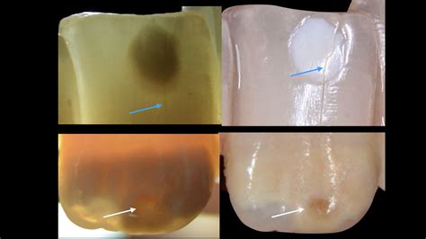 The Use Of Transillumination In Mapping Demarcated Enamel Opacities In