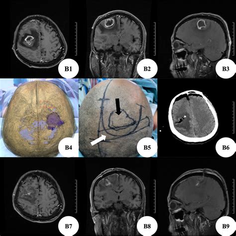 B1b3 Enhanced Brain Mri Showed Space Occupying Lesions In The Right