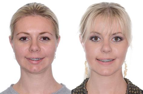 Corrective Jaw Surgery Complete Face Makeover Corrective Jaw Surgery