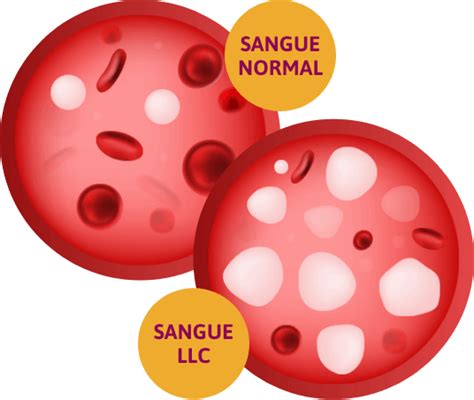 Llc O Que A Leucemia Linfoc Tica Cr Nica Llc Saudeflix