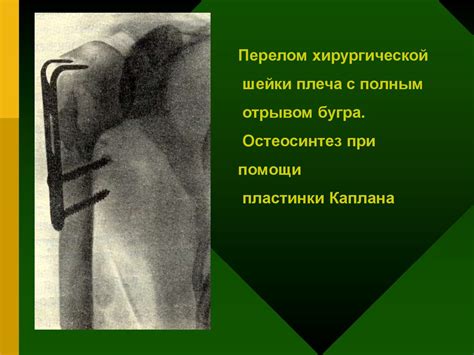 Повреждение плеча, вывихи плеча и предплечья - online presentation