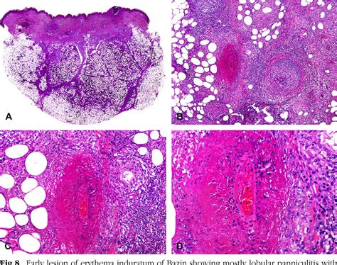 Erythema Induratum Histopathology