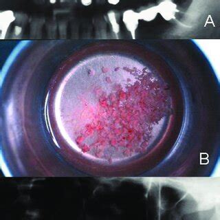 Autogenous Bone A X Ray Showing A Pneumatized Maxillary Sinus B