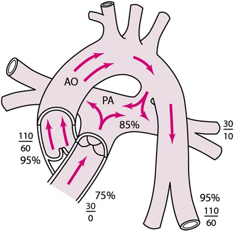 Persistierender Ductus Arteriosus Pda Pädiatrie Msd Manual Profi