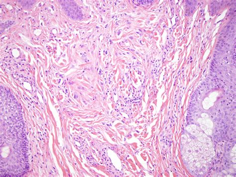 Fibrous Papule | Dermatopathology