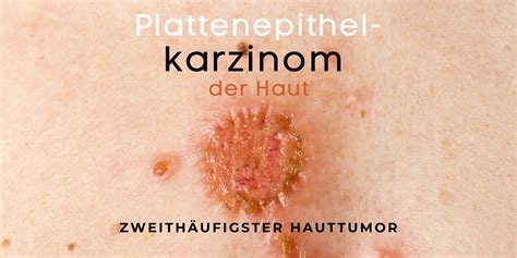 Heller Hautkrebs Plattenepithelkarzinom Auf Was Muss Man Achten