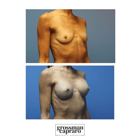 Breast Augmentation Grossman Capraro Plastic Surgery