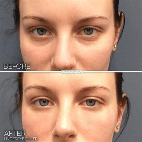 Injections For Dark Circles