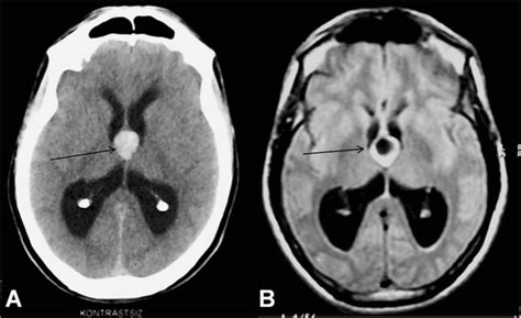 A 46 Year Old Male Patient With A Colloid Cyst Axial Download Scientific Diagram