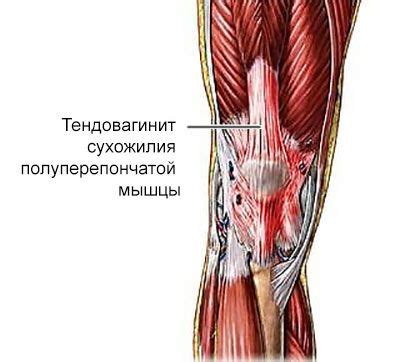 Боль в колене сбоку с внешней стороны основные причины лечение