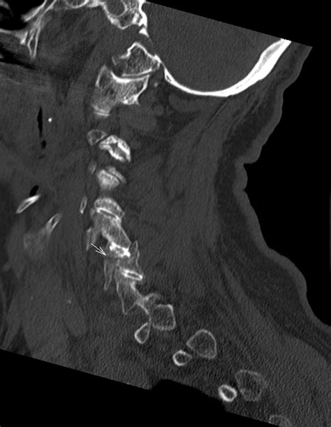 Radiopaedia case Complex cervical spine fracture id: 94313 study ...