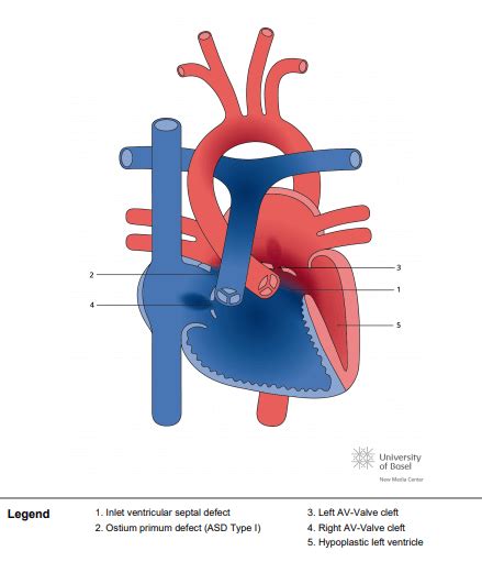 Unbalanced Complete Atrioventricular Septal Defect AVSD With Right