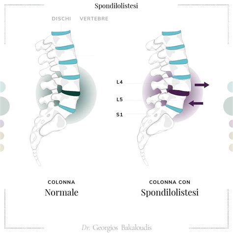 Spondilolistesi L5 S1 Cause Sintomi E Percorso Di Cure