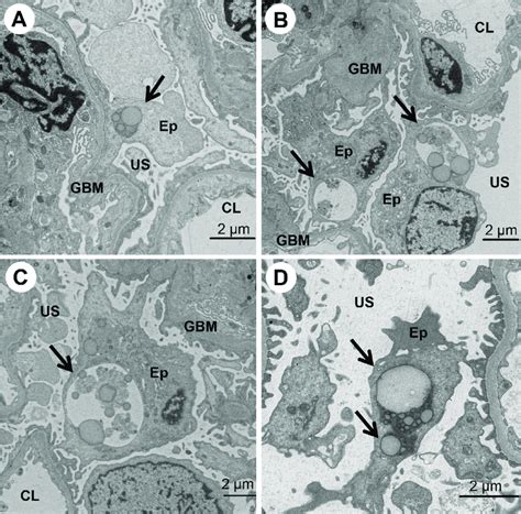 The Ultrastructural Morphology Of Autophagy In Glomerular Podocytes As