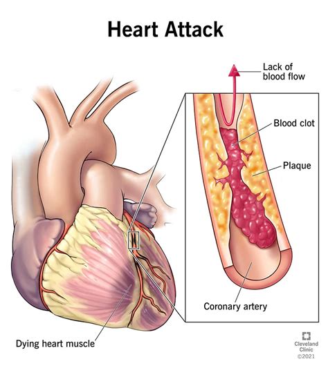 The Most Common Heart Diseases in Recent Years