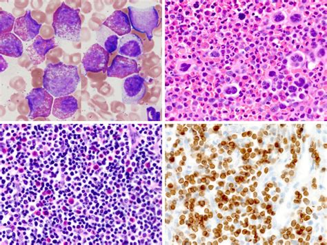 A B Bone Marrow Smears Showing Marked Eosinophilia Matured Myeloid